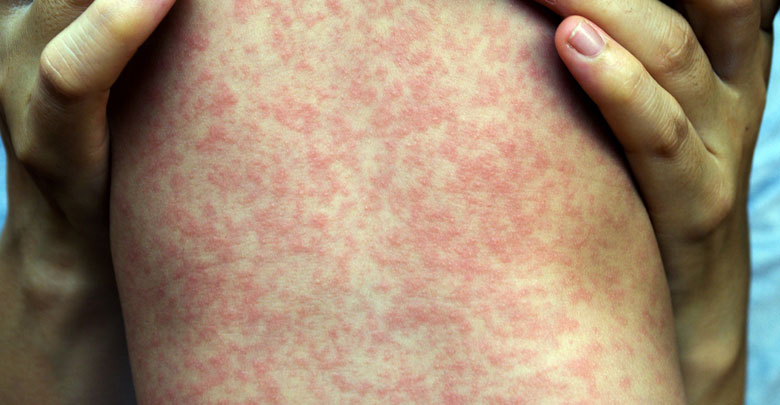 Secretaría de Salud emite aviso epidemiológico por sarampión